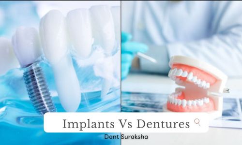 Dental Implants Vs Dentures-Did you choose the right one