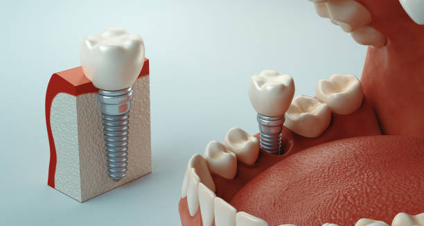 Dental Implants—A solution to Missing Teeth