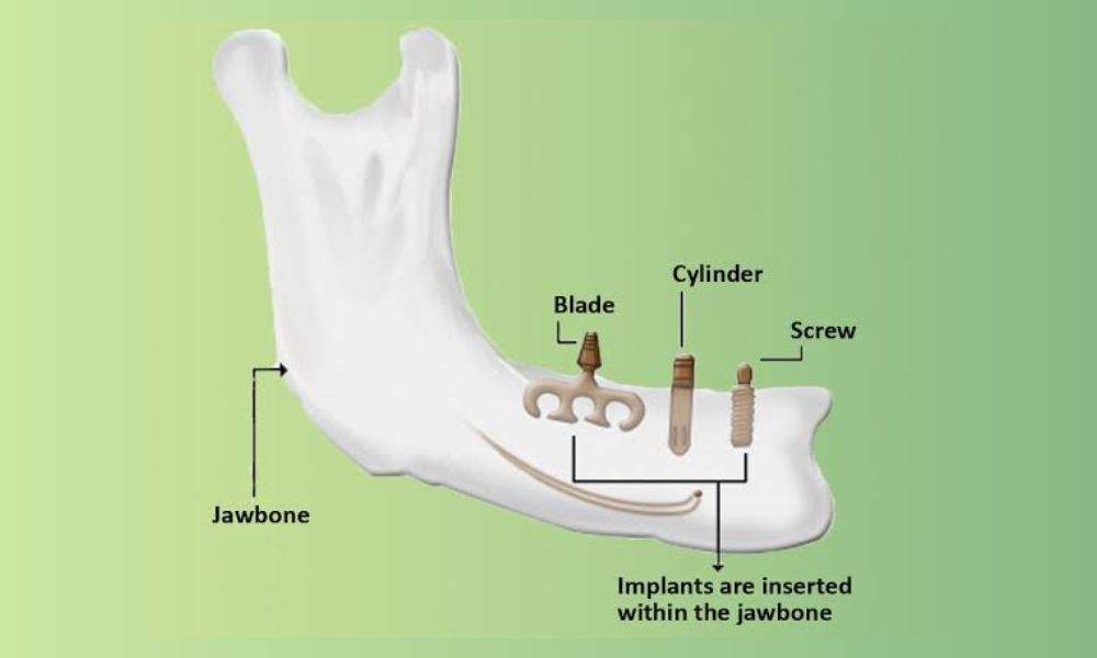 Endosteal Dental Implants In Delhi