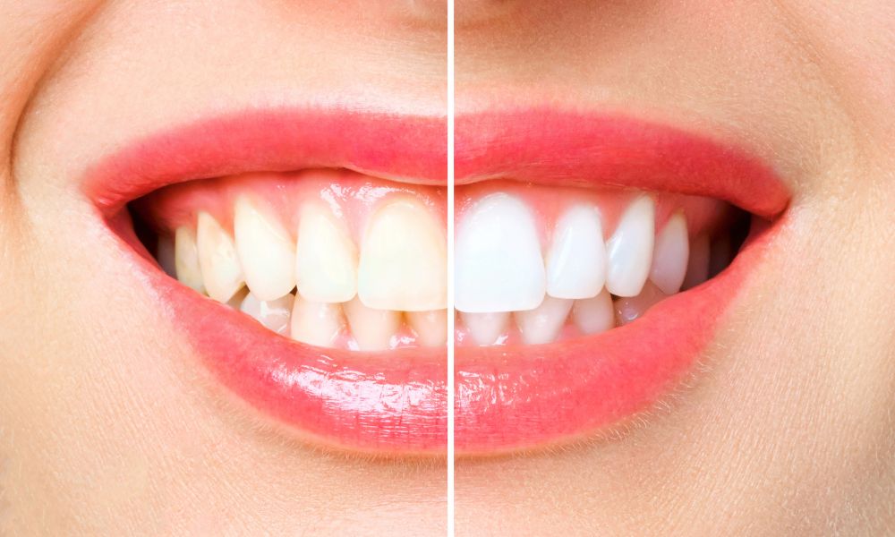 Teeth Whitening - Internal Whitening