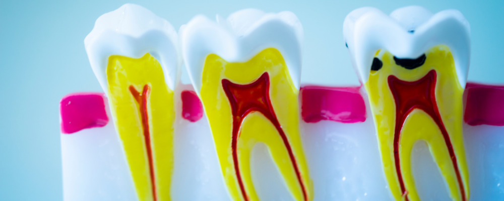 Why root canal is needed