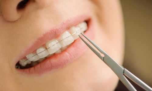 Ceramic braces are popular with adults.