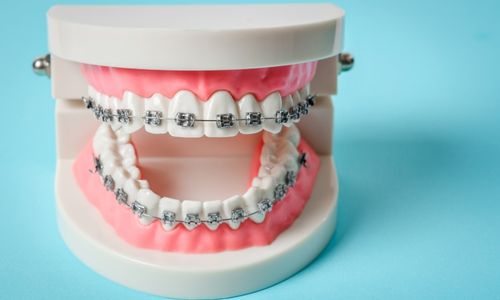Traditional braces are far less invasive.