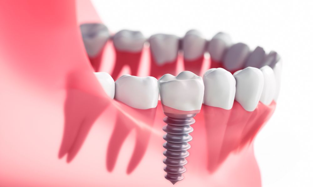 Why Dental Implants are worth it