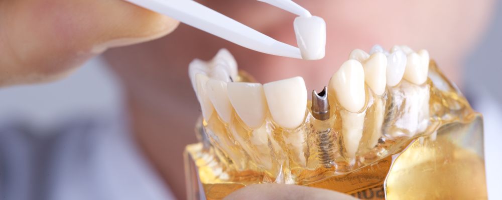 Why to choose Dental Implants