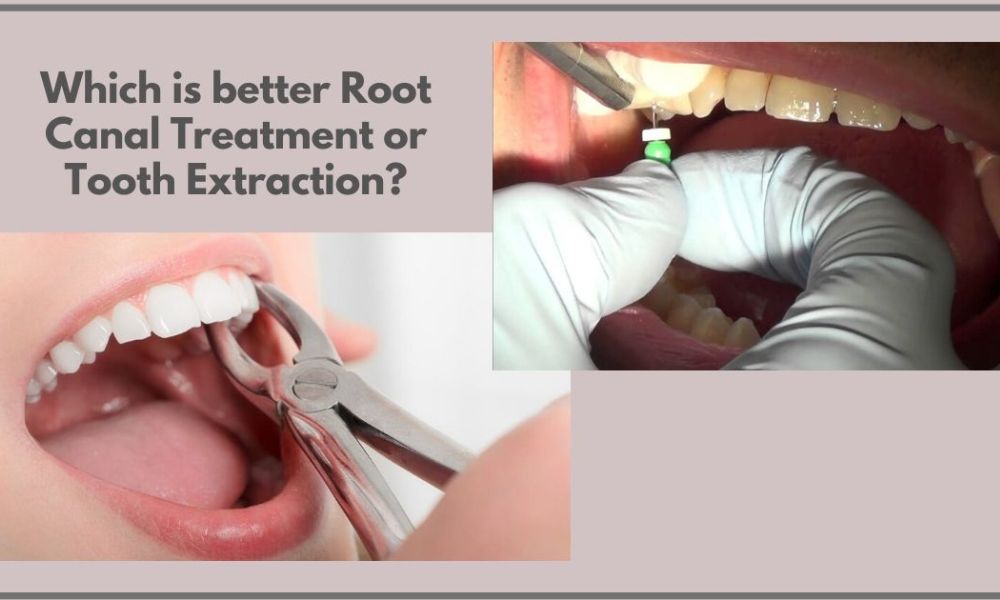Tooth extraction and RCT