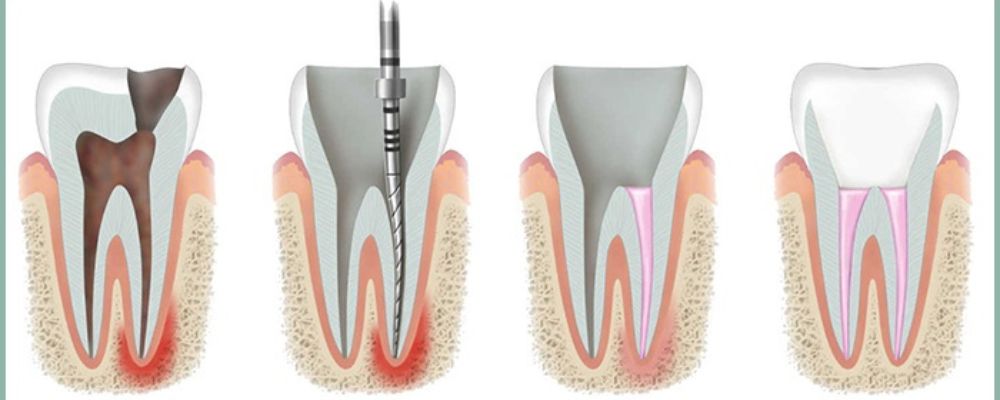 Unveiling Root Canal Treatment (RCT)