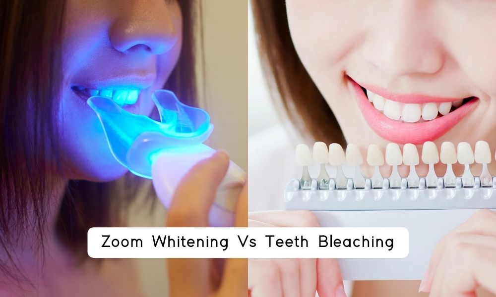 Zoom Whitening Vs Teeth Bleaching