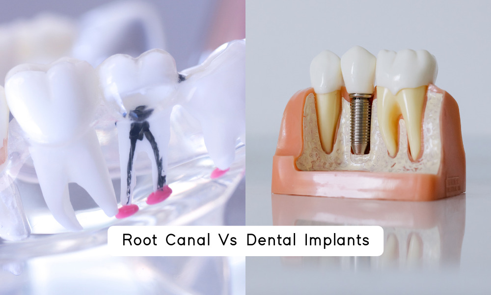 Root Canal Vs Dental Implants