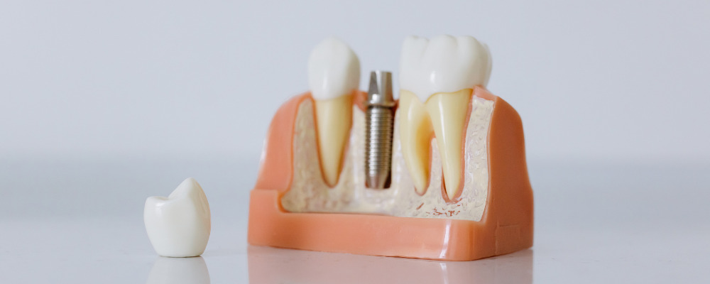 Dental implants are prosthetic tooth roots