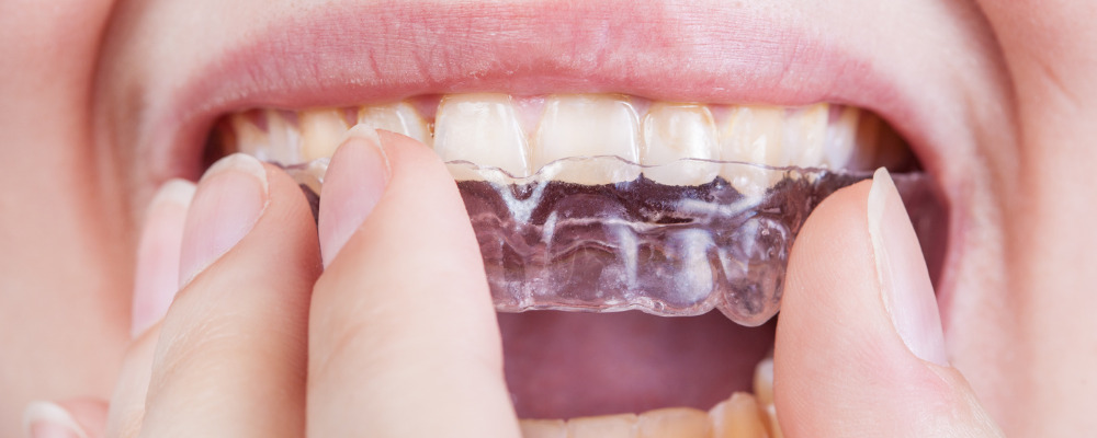 Clear aligners are removable.