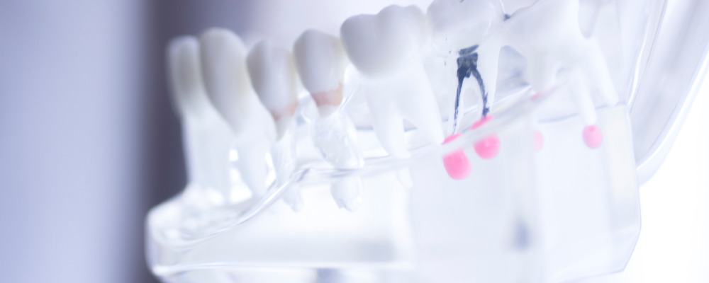 Root Canal Treatment preserve the natural structure and function of your tooth