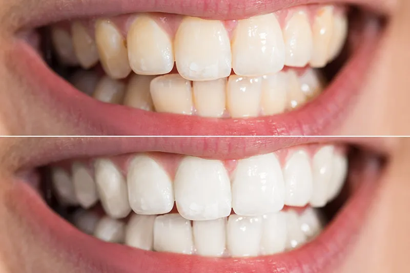 Zoom Teeth Whitening Treatment in Dilshad Garden