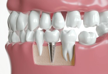 Dental Implants In Dilshad Garden