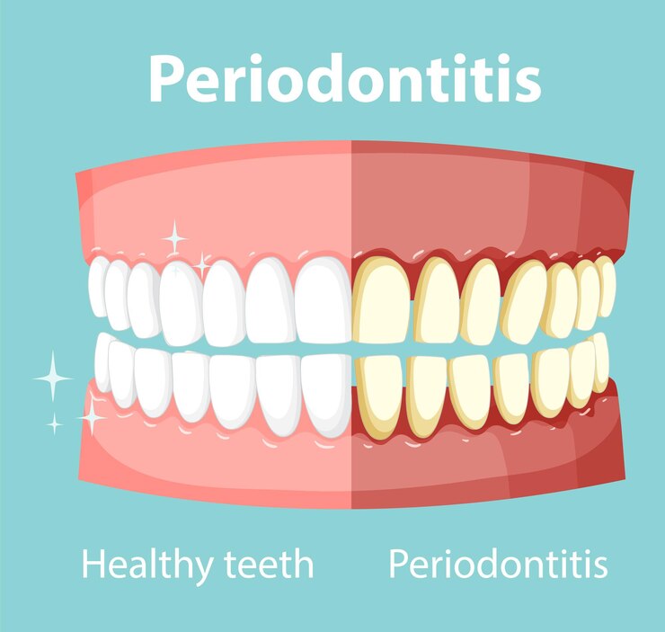 Periodontics Treatment In Dilshad Garden