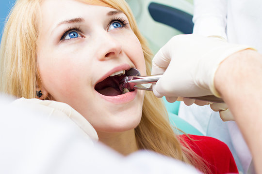 Wisdom Tooth Extractions in Dilshad Garden