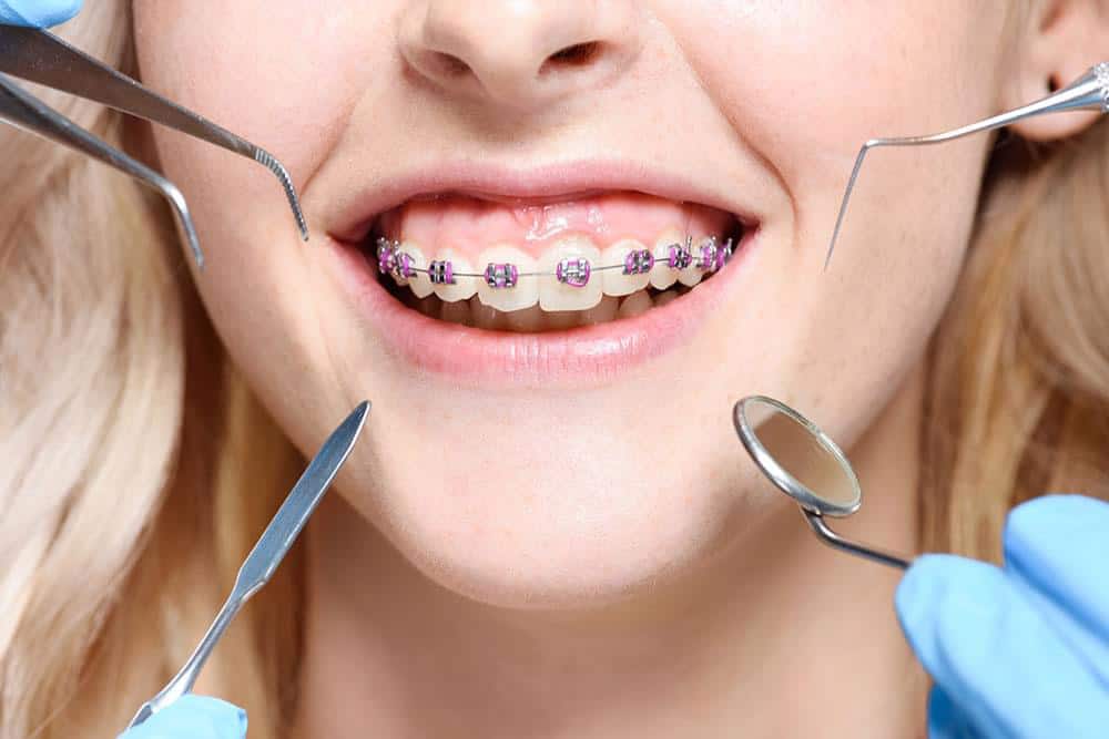 Orthodontic Dental Treatment in Delhi