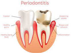 Periodontics Treatment In Delhi