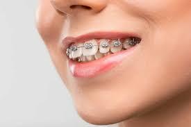 best Orthodontics in Dilshad Garden