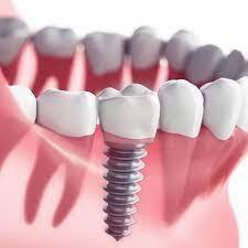 Dental Implant Treatment in Dilshad Garden