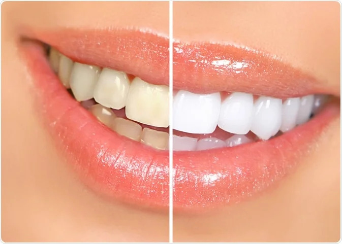 Teeth Whitening Treatment in Jhilmil