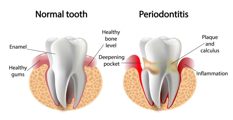 Periodontitis Treatment in Dilshad Garden