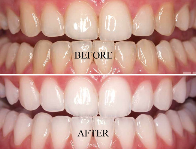 Teeth Whitening in Delhi