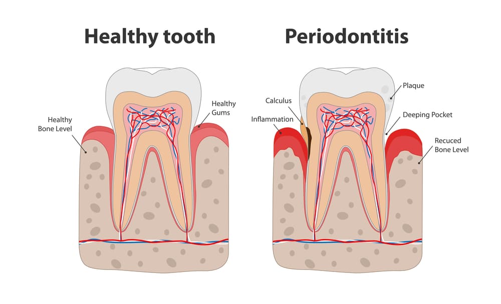 Periodontitis Treatment in Dilshad Garden