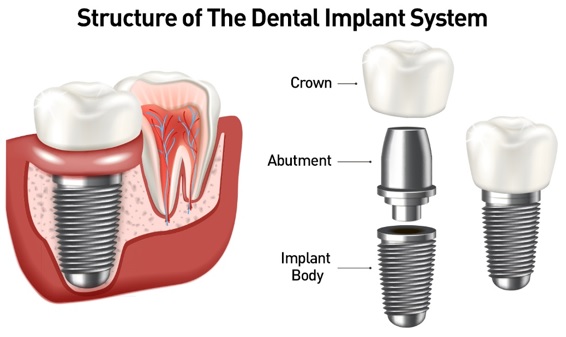 Dental Implant Treatment in East Delhi