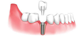 Dental Implant Treatment in Dilshad Garden