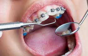 best Orthodontics in Dilshad Garden