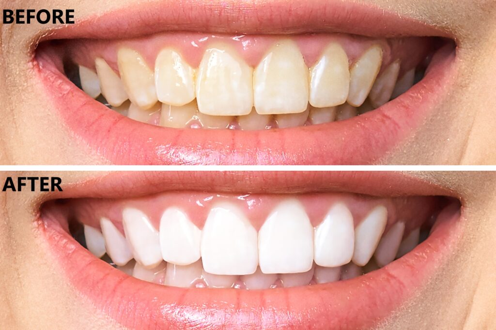 Teeth Whitening