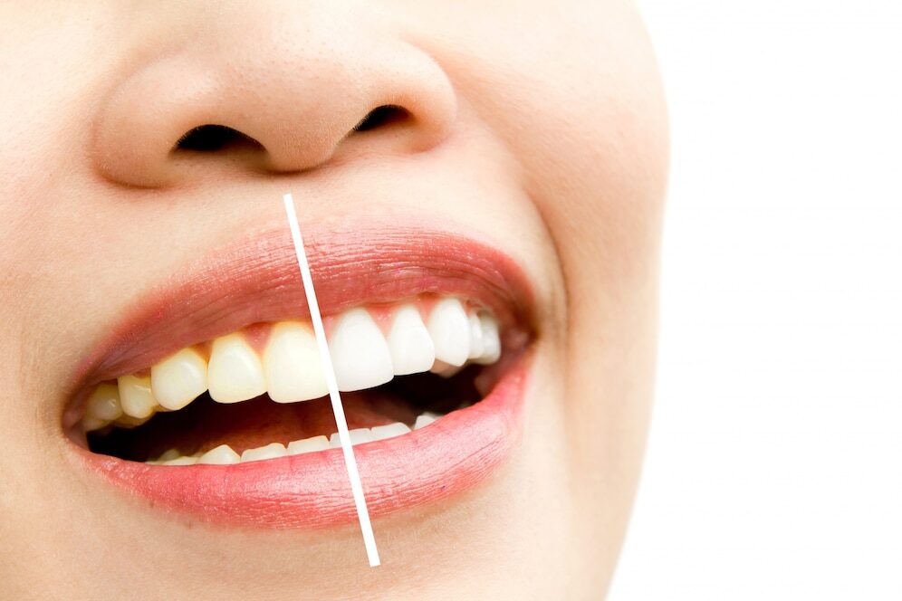 Best Teeth Whitening Treatment in Shahdara