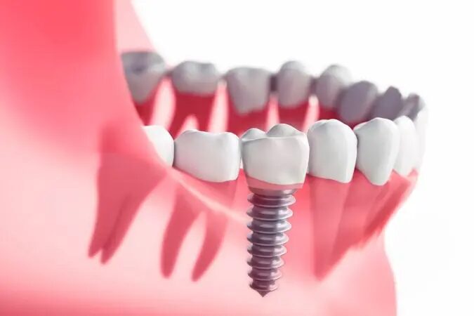 Best Dental Implants Treatment in Shahdara