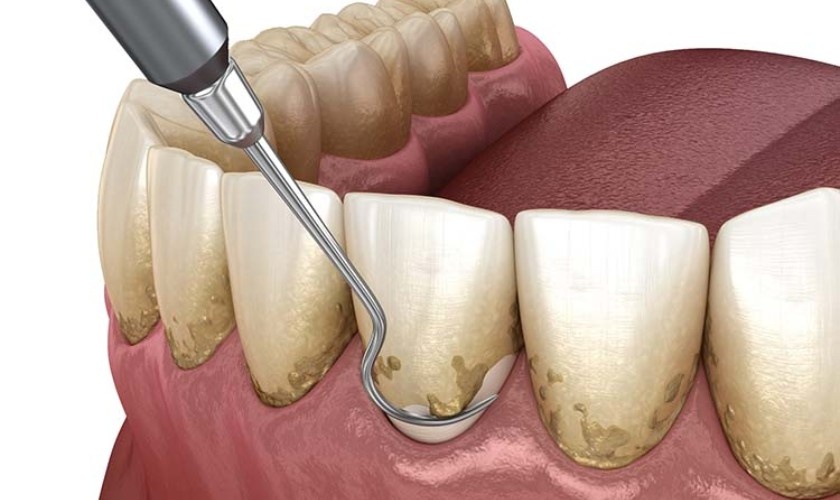 Best Periodontal Treatment in Shalimar Garden