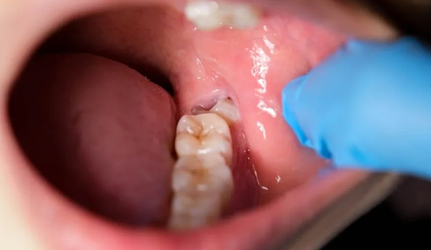 Best Dentist for Wisdom Tooth Removal in Delhi