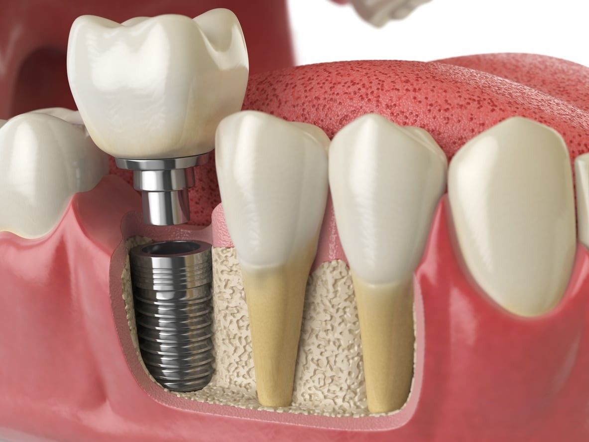 Best Dental Implant Treatment in East Delhi