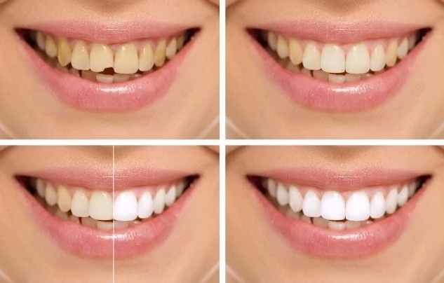 Best Smile Makeover in Delhi