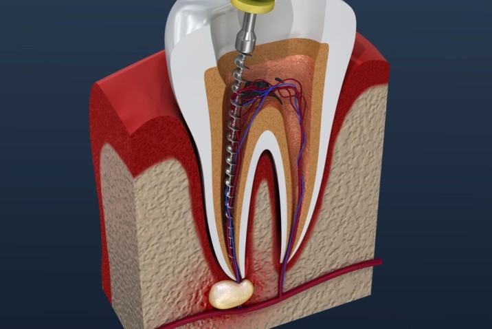 Best Root Canal Treatment in Delhi