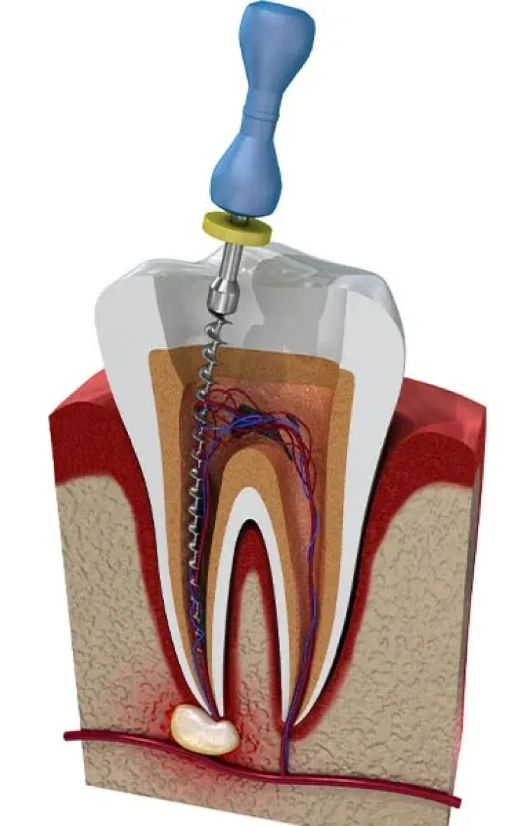 Best Root Canal Treatment in Delhi
