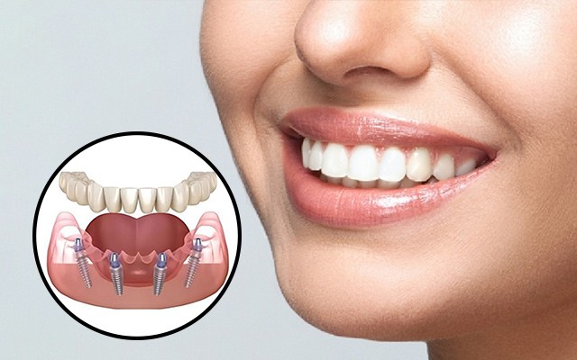 Dental Implant Cost in Delhi