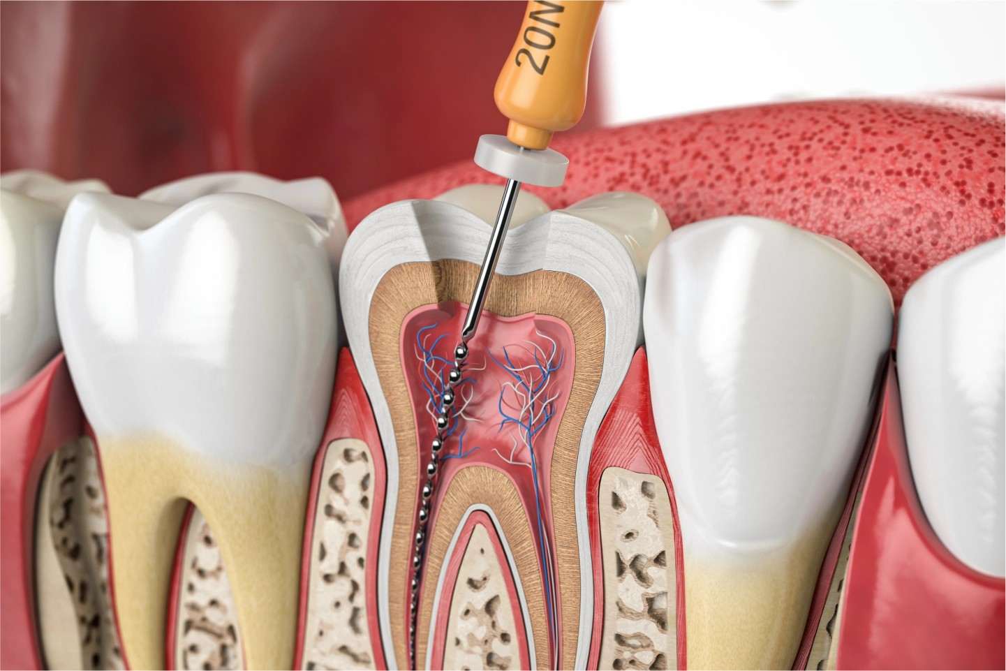 Root Canal Treatment in East Delhi