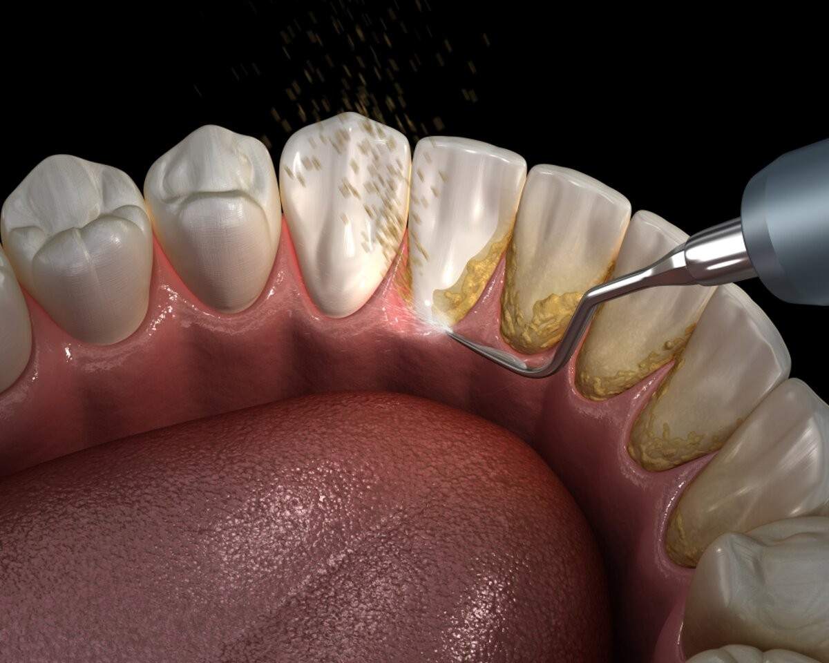 Teeth Cleaning in Delhi