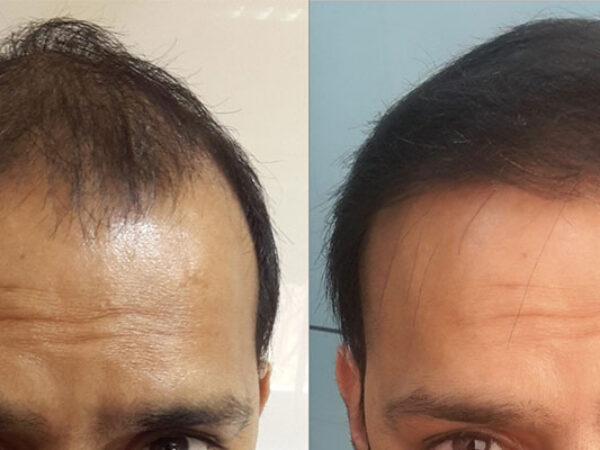 Bio Fibre Hair Implant