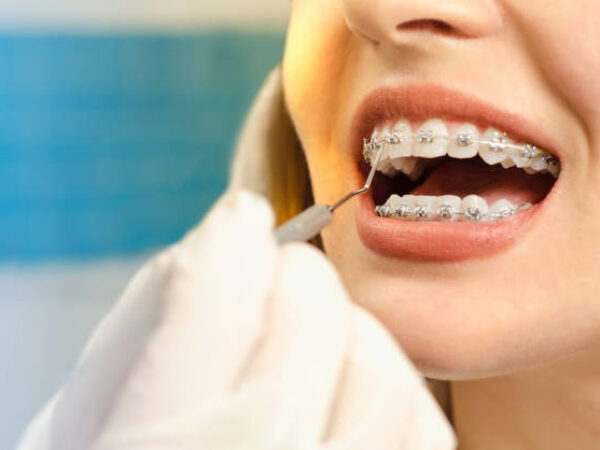 Closeup dental braces checkup , perfect white teeth with dental braces woman in half smile