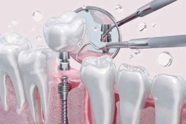 dental-teeth-implant-placement-titanium-260nw-2580069459